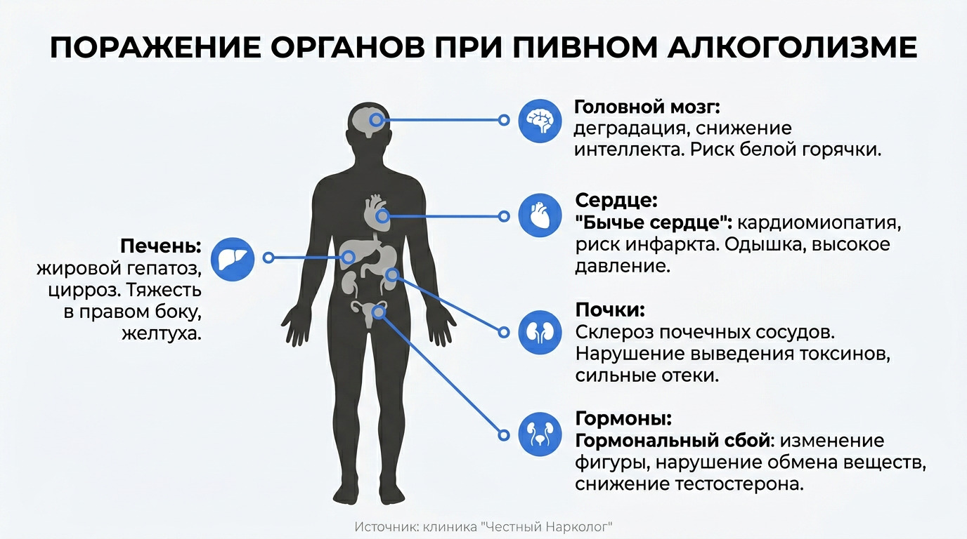 Инфографика: анатомический атлас поражения органов (мозг, сердце, печень, почки, гормональная система) при пивном алкоголизме